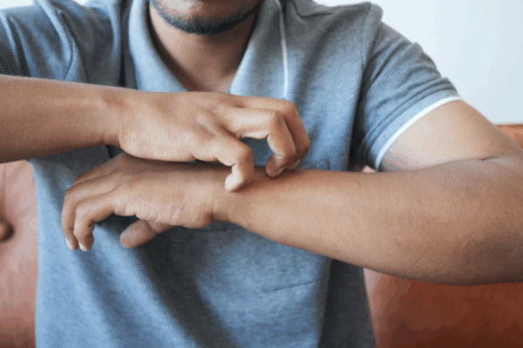 Why Scabies Is Making a Quiet Comeback and What You Can Do