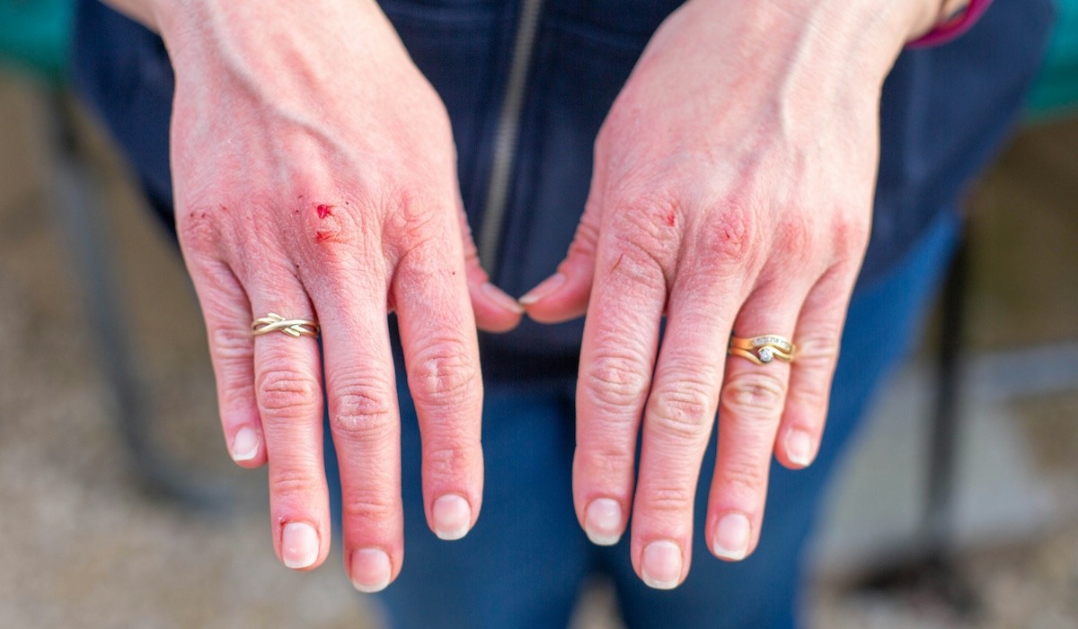 Patient with eczema on their hands.